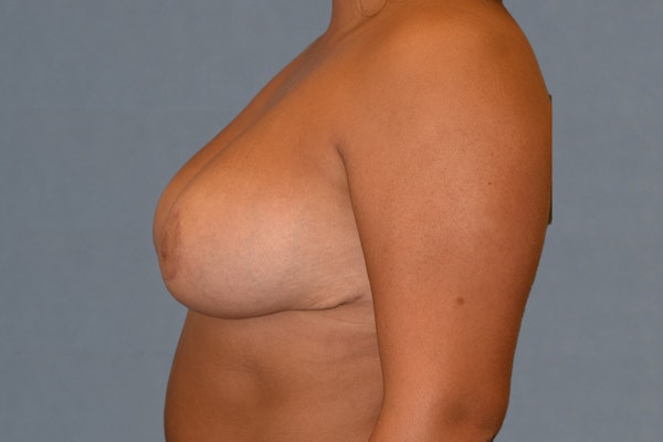 Breast Lift Before & After Gallery - Patient 173565603 - Image 6