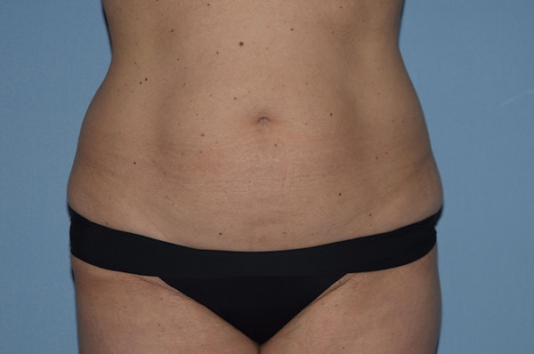 Tummy Tuck Before & After Gallery - Patient 173565613 - Image 1