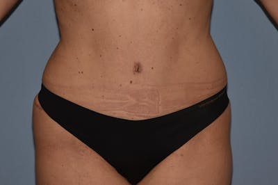 Tummy Tuck Before & After Gallery - Patient 173565613 - Image 2