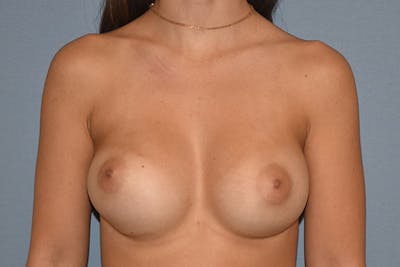 Breast Revision Before & After Gallery - Patient 173565615 - Image 1