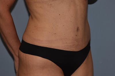 Tummy Tuck Before & After Gallery - Patient 173565613 - Image 4