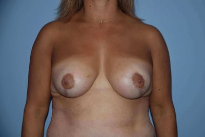 Breast Reduction Before & After Gallery - Patient 173565619 - Image 2