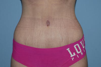 Tummy Tuck Before & After Gallery - Patient 173565624 - Image 2