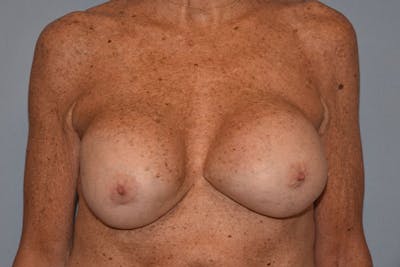 Breast Revision Before & After Gallery - Patient 173565625 - Image 1