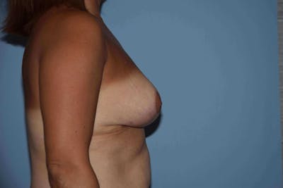 Breast Reduction Before & After Gallery - Patient 173565619 - Image 6