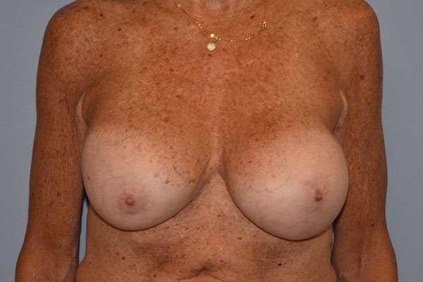 Breast Revision Before & After Gallery - Patient 173565625 - Image 2