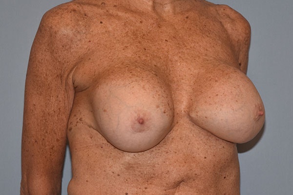 Breast Revision Before & After Gallery - Patient 173565625 - Image 3