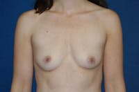 Breast Augmentation Before & After Gallery - Patient 173565630 - Image 1