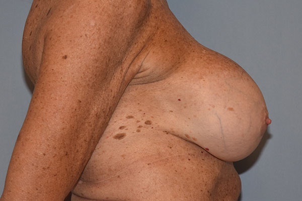 Breast Revision Before & After Gallery - Patient 173565625 - Image 5