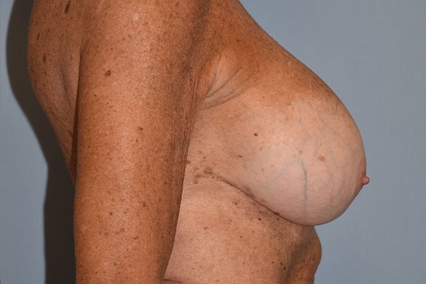 Breast Revision Before & After Gallery - Patient 173565625 - Image 6