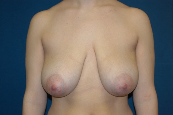 Breast Lift Before & After Gallery - Patient 173565634 - Image 1