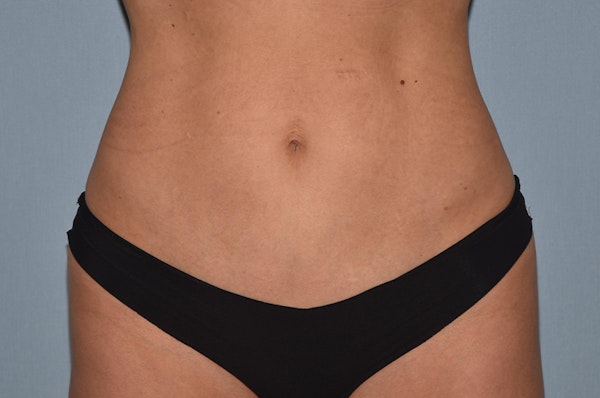 Tummy Tuck Before & After Gallery - Patient 173565632 - Image 2