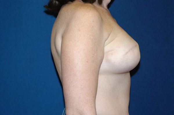 Breast Reconstruction Before & After Gallery - Patient 173565635 - Image 5