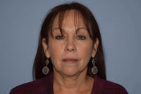 Facelift Before & After Gallery - Patient 173565645 - Image 1