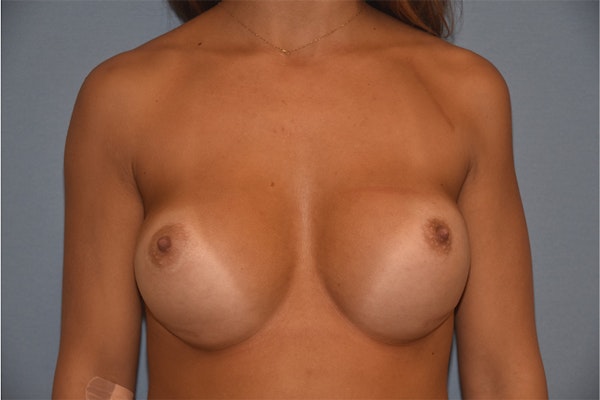 Breast Revision Before & After Gallery - Patient 173565644 - Image 1