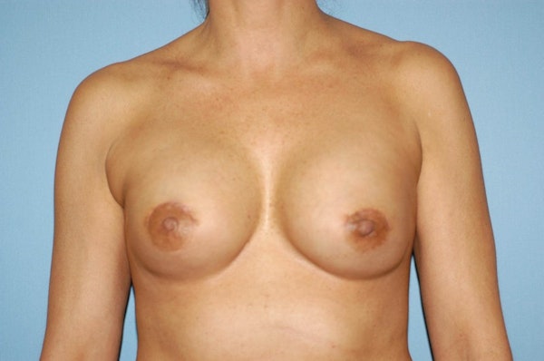 Breast Reconstruction Before & After Gallery - Patient 173565646 - Image 2