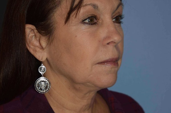 Facelift Before & After Gallery - Patient 173565645 - Image 3