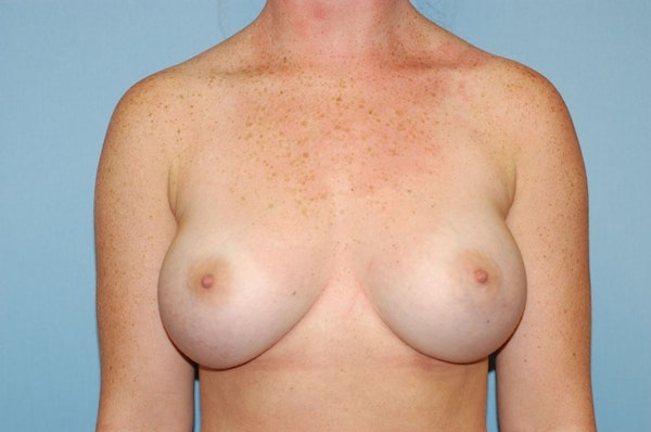 Breast Augmentation Before & After Gallery - Patient 173565650 - Image 2