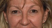 Eyelid Lift Before & After Gallery - Patient 173565649 - Image 1