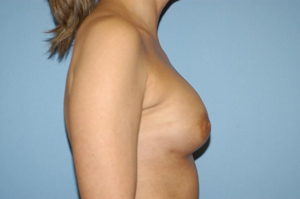 Breast Reconstruction Before & After Gallery - Patient 173565646 - Image 6