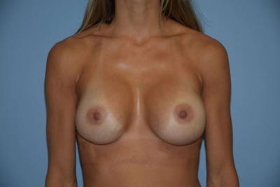 Breast Revision Before & After Gallery - Patient 173565654 - Image 2