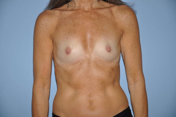 Breast Reconstruction Before & After Gallery - Patient 173565659 - Image 1