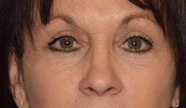 Eyelid Lift Before & After Gallery - Patient 173565651 - Image 2