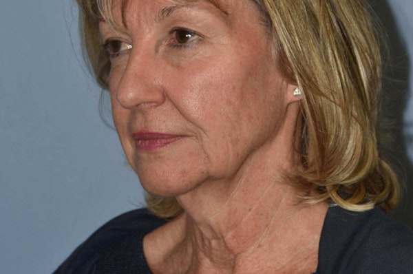 Facelift Before & After Gallery - Patient 173565661 - Image 3