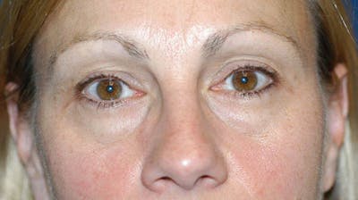 Eyelid Lift Before & After Gallery - Patient 173565655 - Image 1
