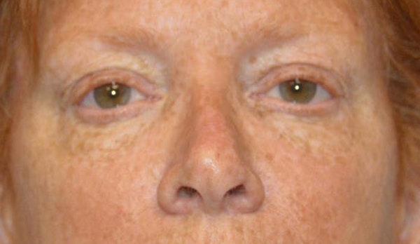 Eyelid Lift Before & After Gallery - Patient 173565662 - Image 1