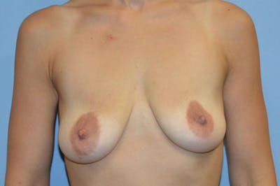 Breast Augmentation Lift Before & After Gallery - Patient 173565673 - Image 1