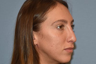 Rhinoplasty Before & After Gallery - Patient 173565666 - Image 6