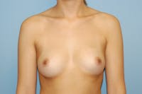 Breast Augmentation Before & After Gallery - Patient 173565738 - Image 1