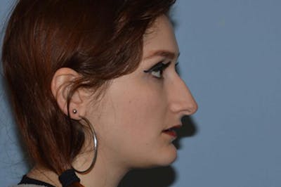 Rhinoplasty Before & After Gallery - Patient 173565739 - Image 1