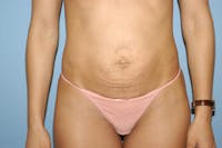 Tummy Tuck Before & After Gallery - Patient 173565741 - Image 1