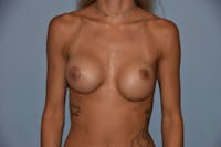 Breast Revision Before & After Gallery - Patient 173565743 - Image 1