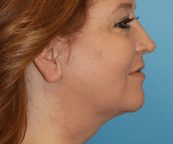 Neck Lift Before & After Gallery - Patient 173565742 - Image 2