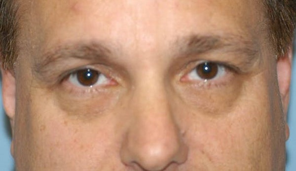 Eyelid Lift Before & After Gallery - Patient 173565746 - Image 1