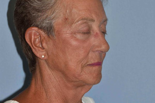 Facelift Before & After Gallery - Patient 173565745 - Image 7