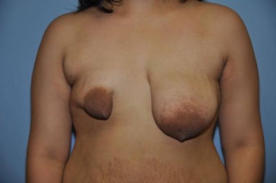 Breast Reconstruction Before & After Gallery - Patient 173565748 - Image 1