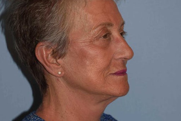 Facelift Before & After Gallery - Patient 173565745 - Image 8