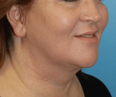 Neck Lift Before & After Gallery - Patient 173565742 - Image 6