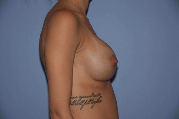 Breast Revision Before & After Gallery - Patient 173565743 - Image 6