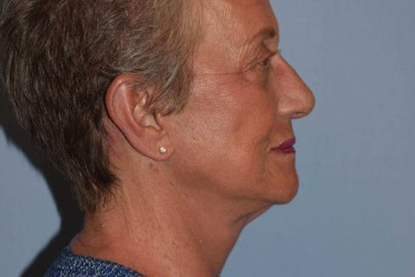 Facelift Before & After Gallery - Patient 173565745 - Image 10