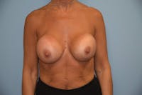 Breast Revision Before & After Gallery - Patient 173565758 - Image 1