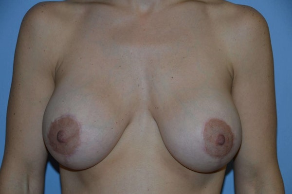 Breast Augmentation Lift Before & After Gallery - Patient 173565753 - Image 2