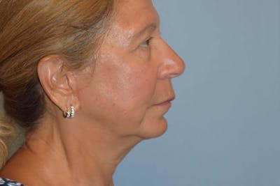 Neck Lift Before & After Gallery - Patient 173565754 - Image 2