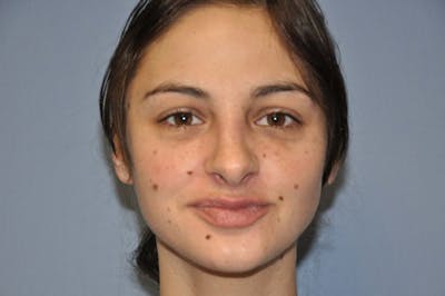 Rhinoplasty Before & After Gallery - Patient 173565756 - Image 4