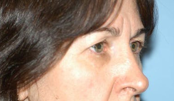 Eyelid Lift Before & After Gallery - Patient 173565757 - Image 3
