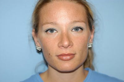 Rhinoplasty Before & After Gallery - Patient 173565767 - Image 4